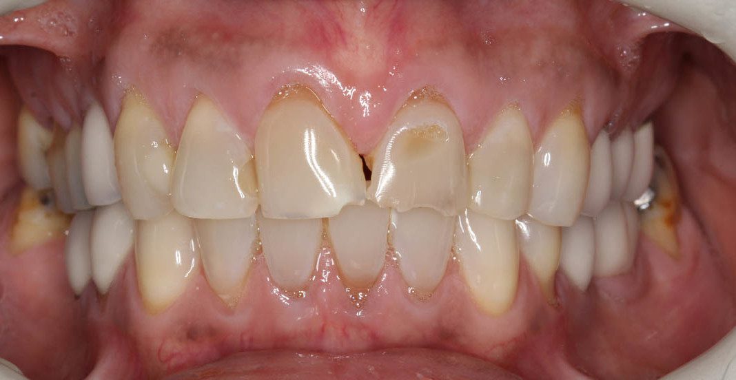Front 6 teeth, severe wear (attrition), Cosmetic (female) Dental