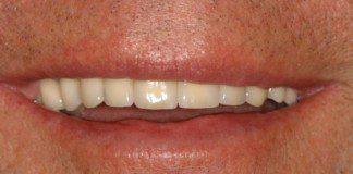 Back implant bridge - upper left