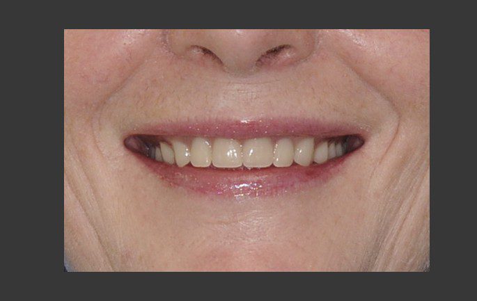 Complete Upper Denture Lower Implant Overdenture - 2 Implants (Female