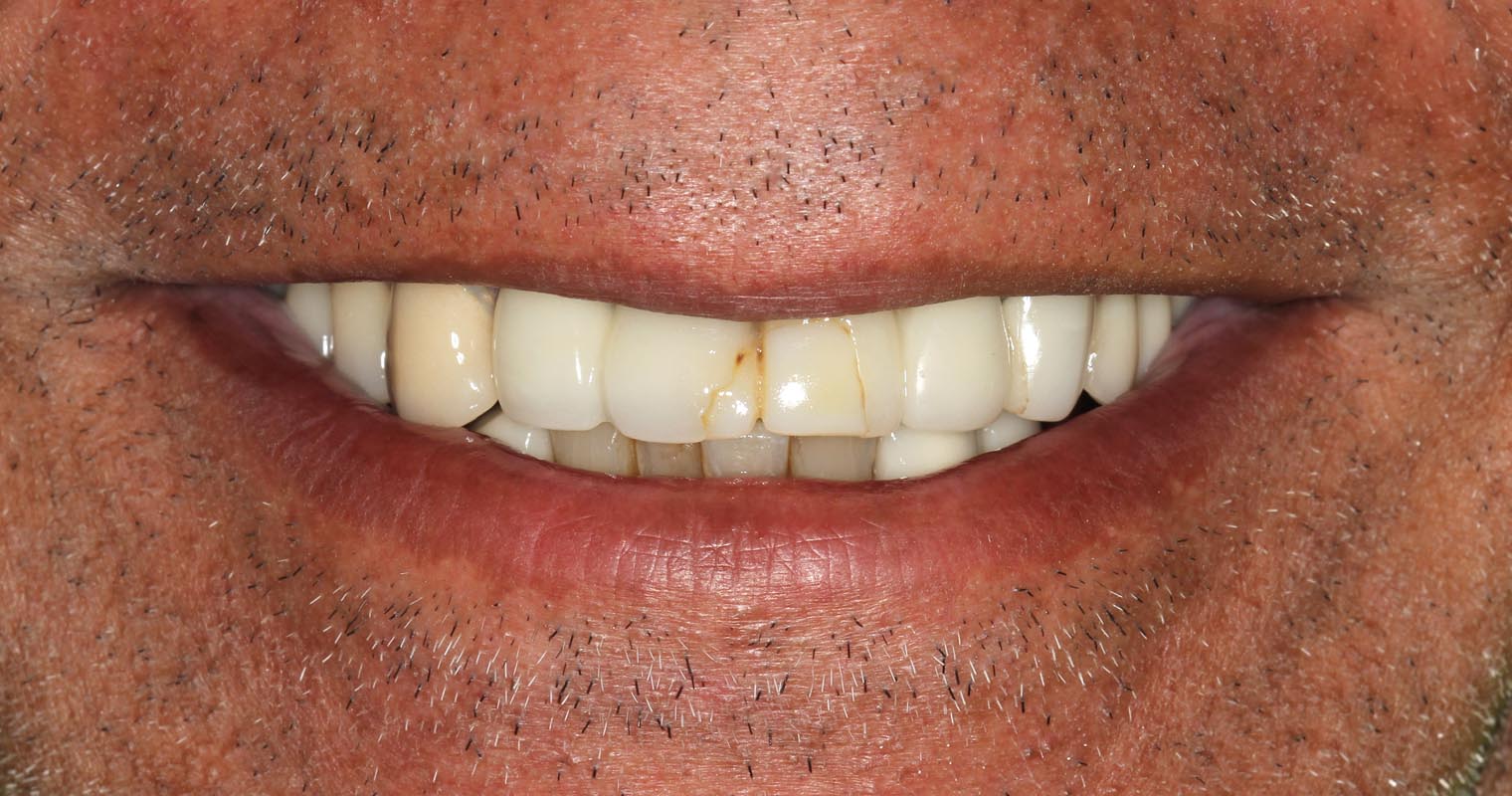 Full Arch/Full Mouth Implant Bridges Before