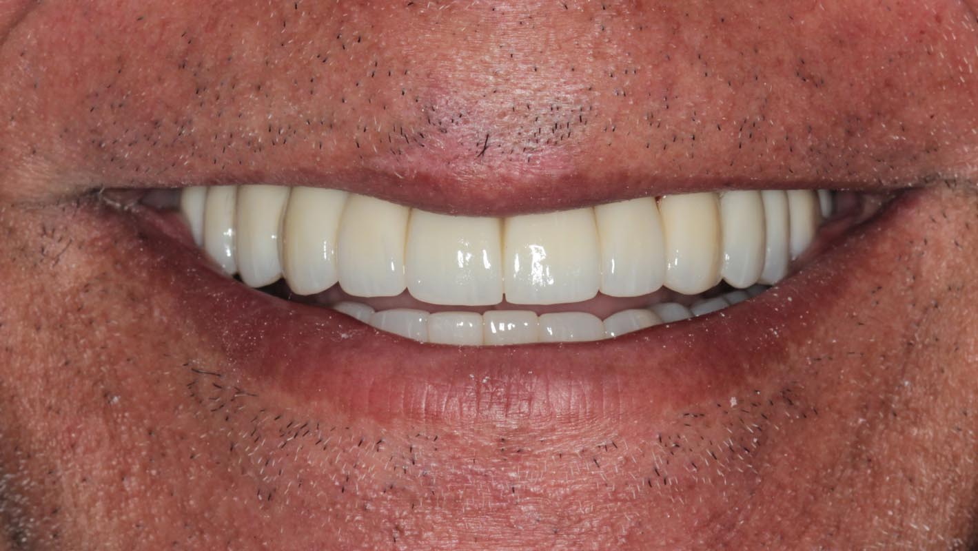 Full Arch/Full Mouth Implant Bridges After