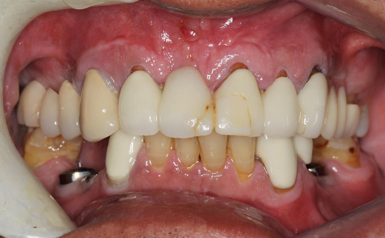 Full Arch/Full Mouth Implant Bridges Before