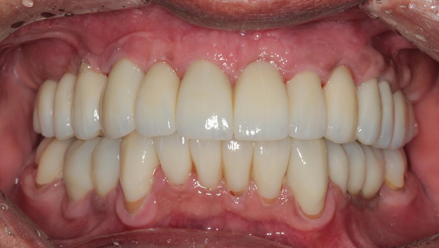 Full Arch/Full Mouth Implant Bridges After