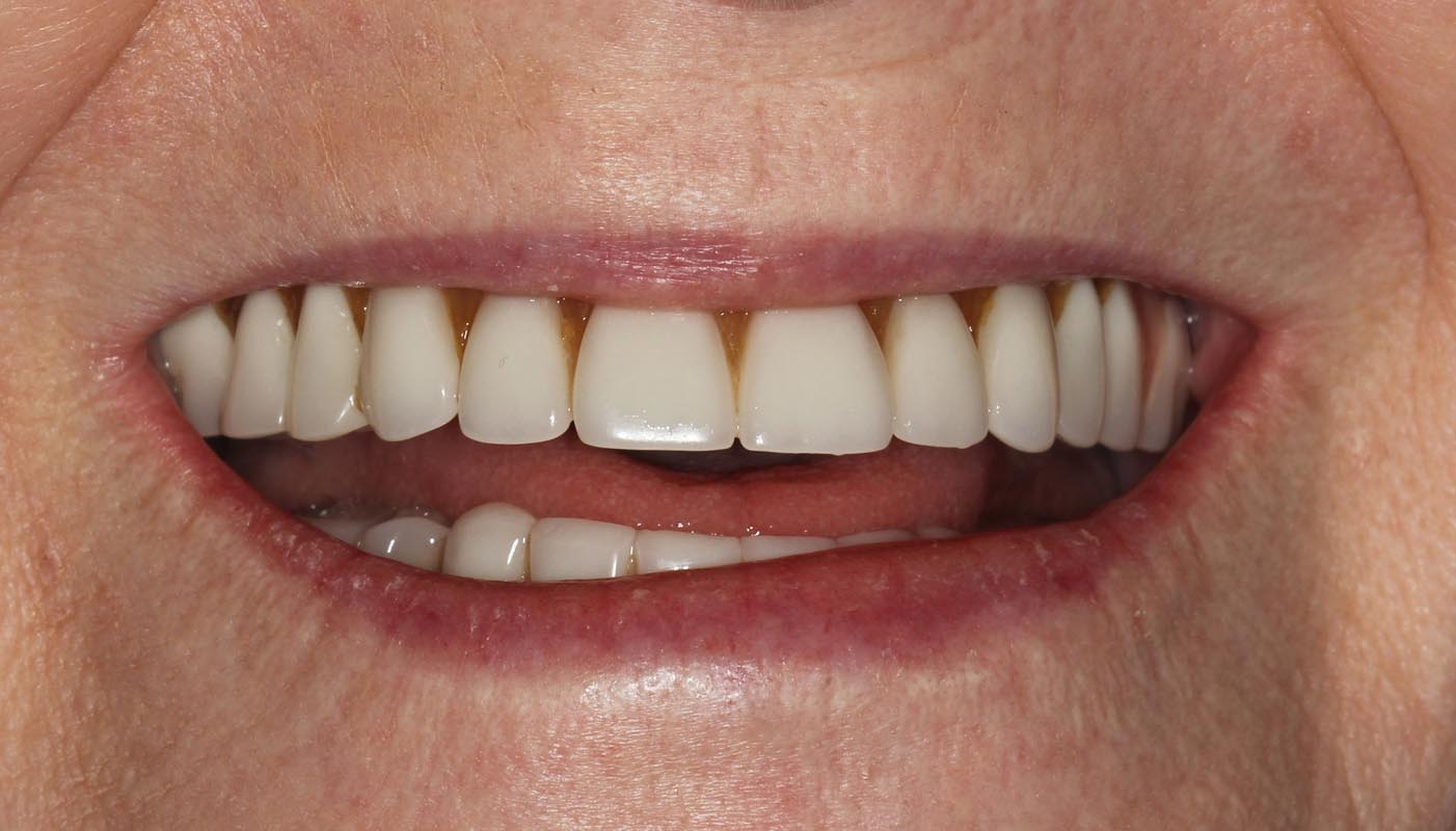 Full Arch/Full Mouth Implant Bridges Before