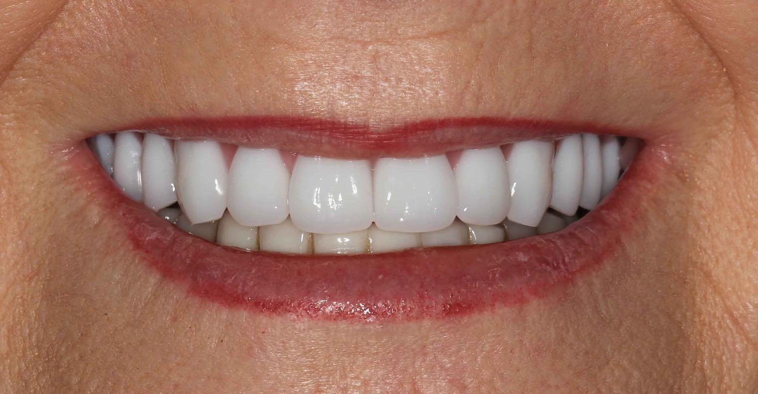 Full Arch/Full Mouth Implant Bridges After