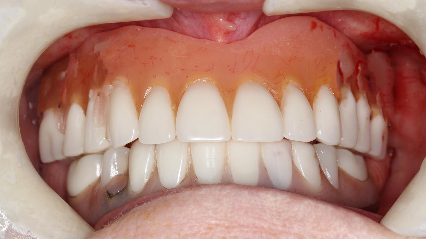 Full Arch/Full Mouth Implant Bridges Before