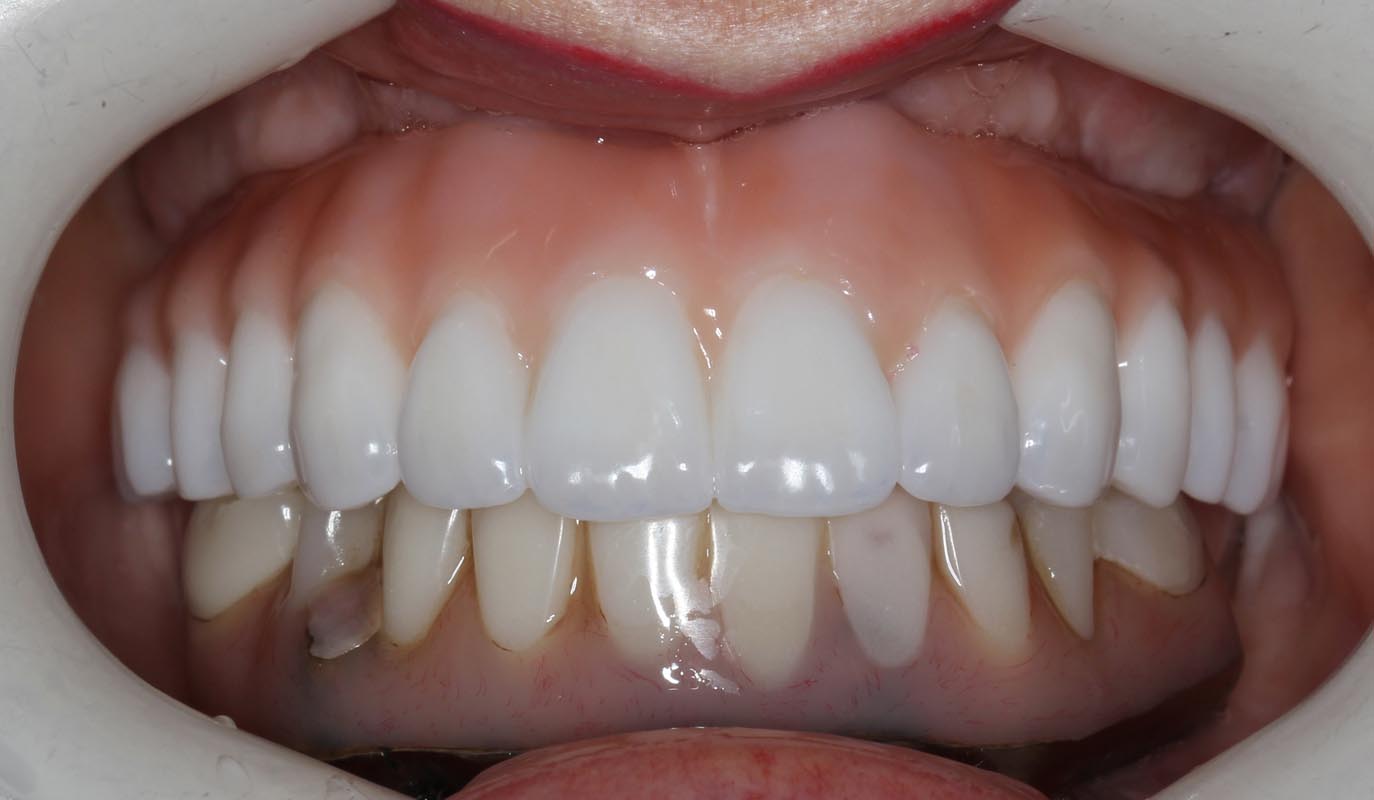 Full Arch/Full Mouth Implant Bridges After