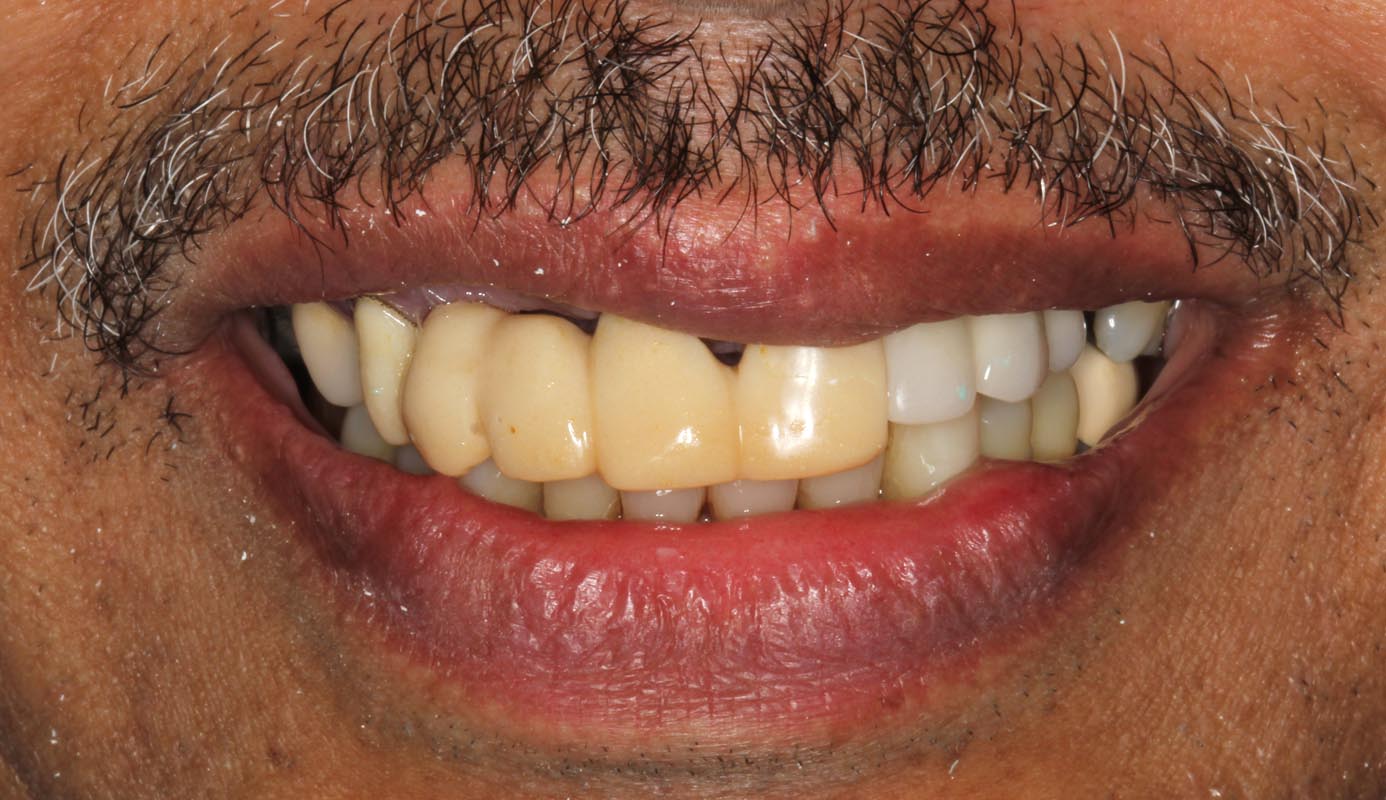 Full Arch/Full Mouth Implant Bridges Before