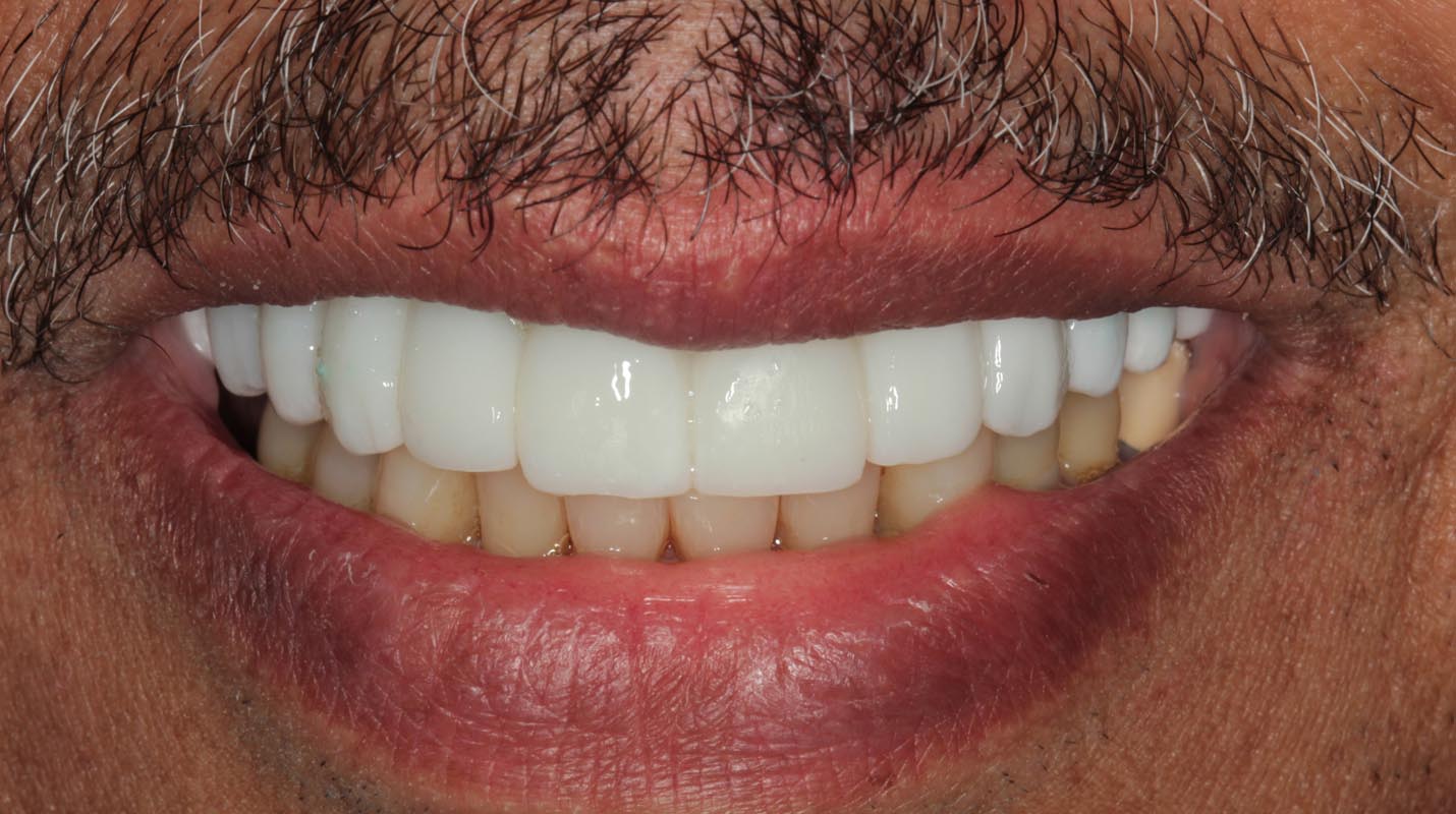 Full Arch/Full Mouth Implant Bridges After