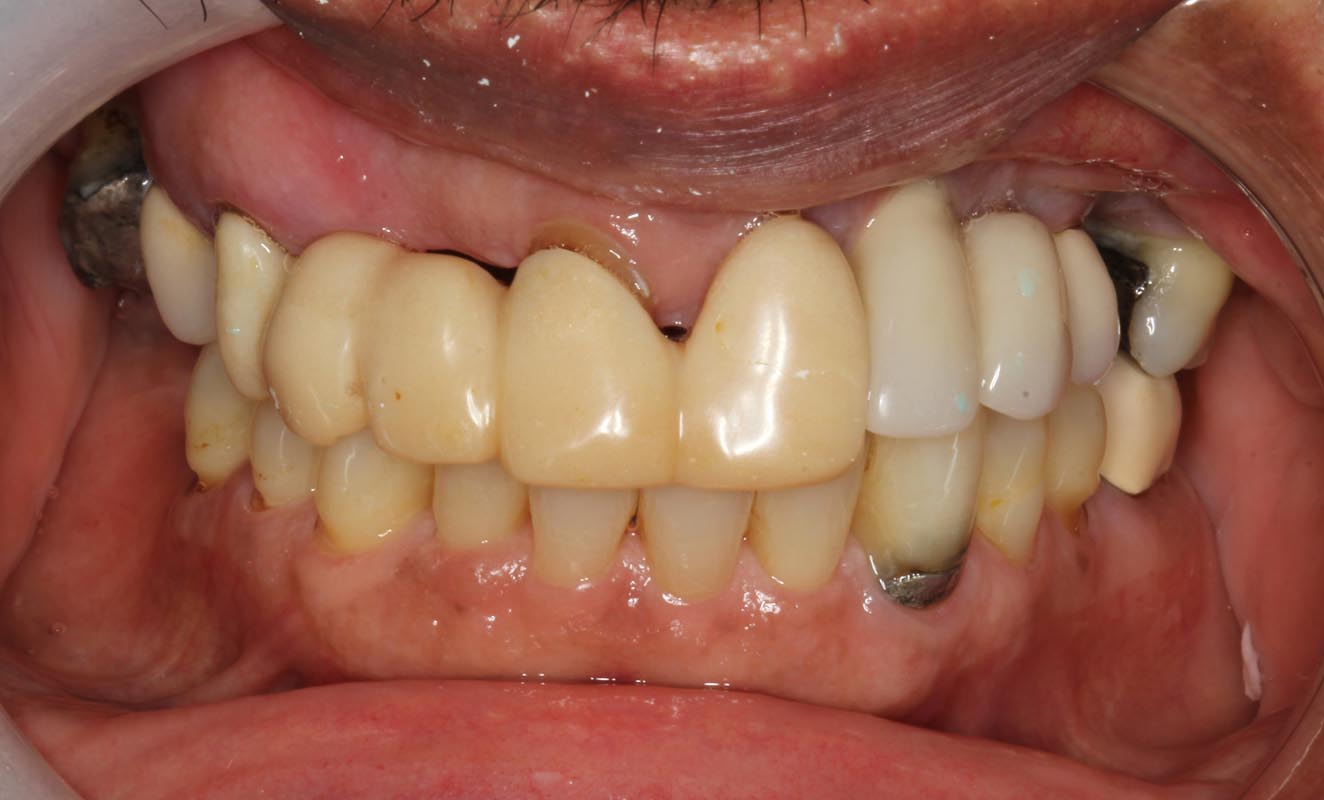 Full Arch/Full Mouth Implant Bridges Before