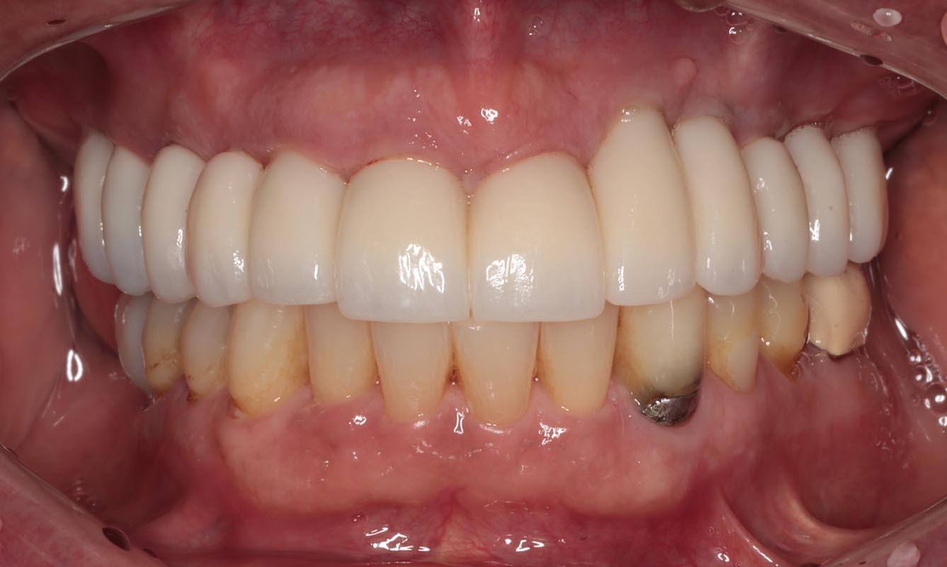 Full Arch/Full Mouth Implant Bridges After