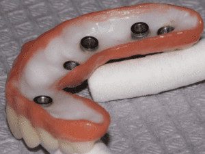 “Incorrect design of fixed implant bridges and dentures, concave, leaves space for food and debris, cannot clean”
