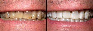 "Teeth whitening, before is yellow and after is white"