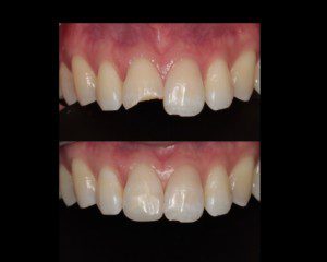 Aesthetic dentistry, Composite Bonding of front teeth
