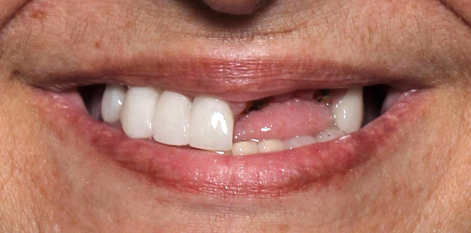 Full Arch/Full Mouth Implant Bridges Before