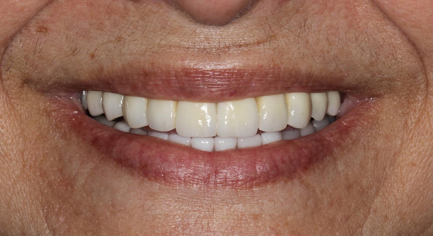 Full Arch/Full Mouth Implant Bridges After