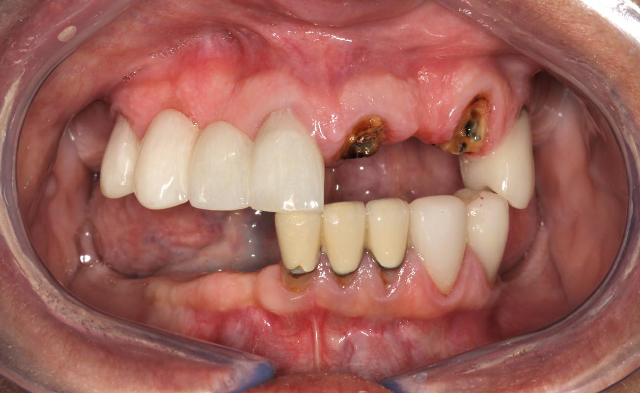 Full Arch/Full Mouth Implant Bridges Before