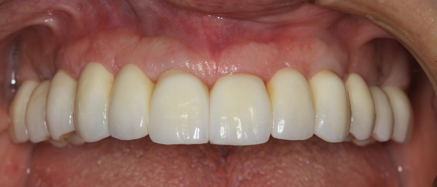 Full Arch/Full Mouth Implant Bridges After