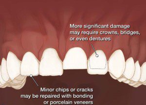 "Top causes of tooth breakage, clenching and grinding habits"