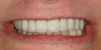 Full Mouth Reconstruction (On Teeth) 2 Cases
