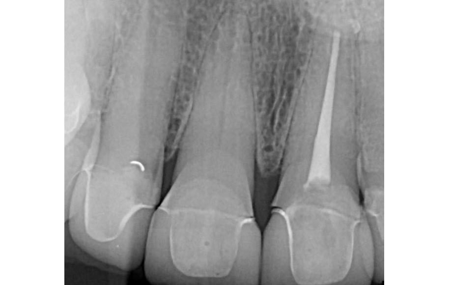 Front Implant Crown Left Central Incisor Fractured Tooth (Female