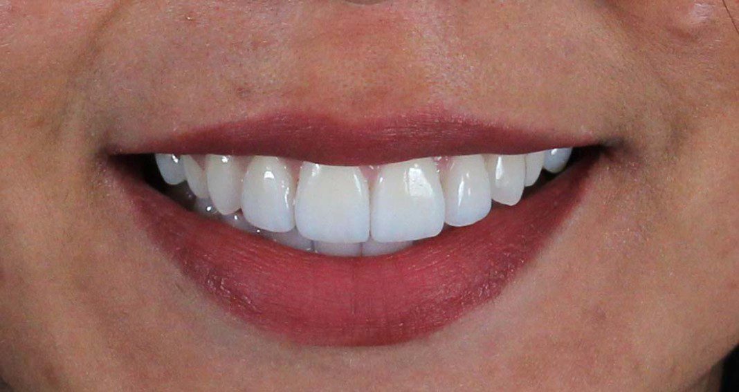 Veneers Case 16A1 5 (Female) Dental Implant Center