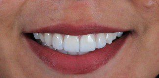 Veneers – Case 16-A1 5 (Female)