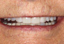 Veneers