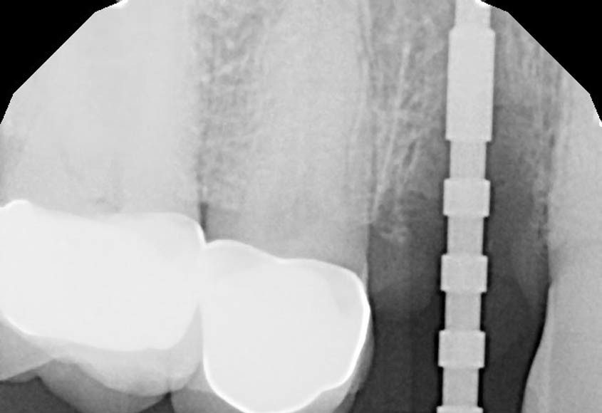 Back Implant Crown, immediate temporary crown