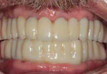 Full Mouth Implant Treatment Two weeks post-op surgery and temporaries (note amazing tissue response)