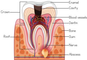 "Top causes of tooth breakage, decay"