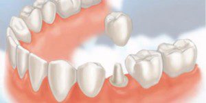 “Procedures done by prosthodontists, crowns"