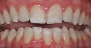 White spots on teeth as a result of excessive baking soda and peroxide use
