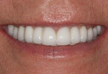 Do Dental Implants Look Like Natural Teeth?
