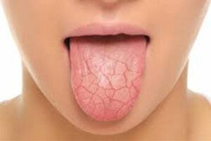 DryMouth4