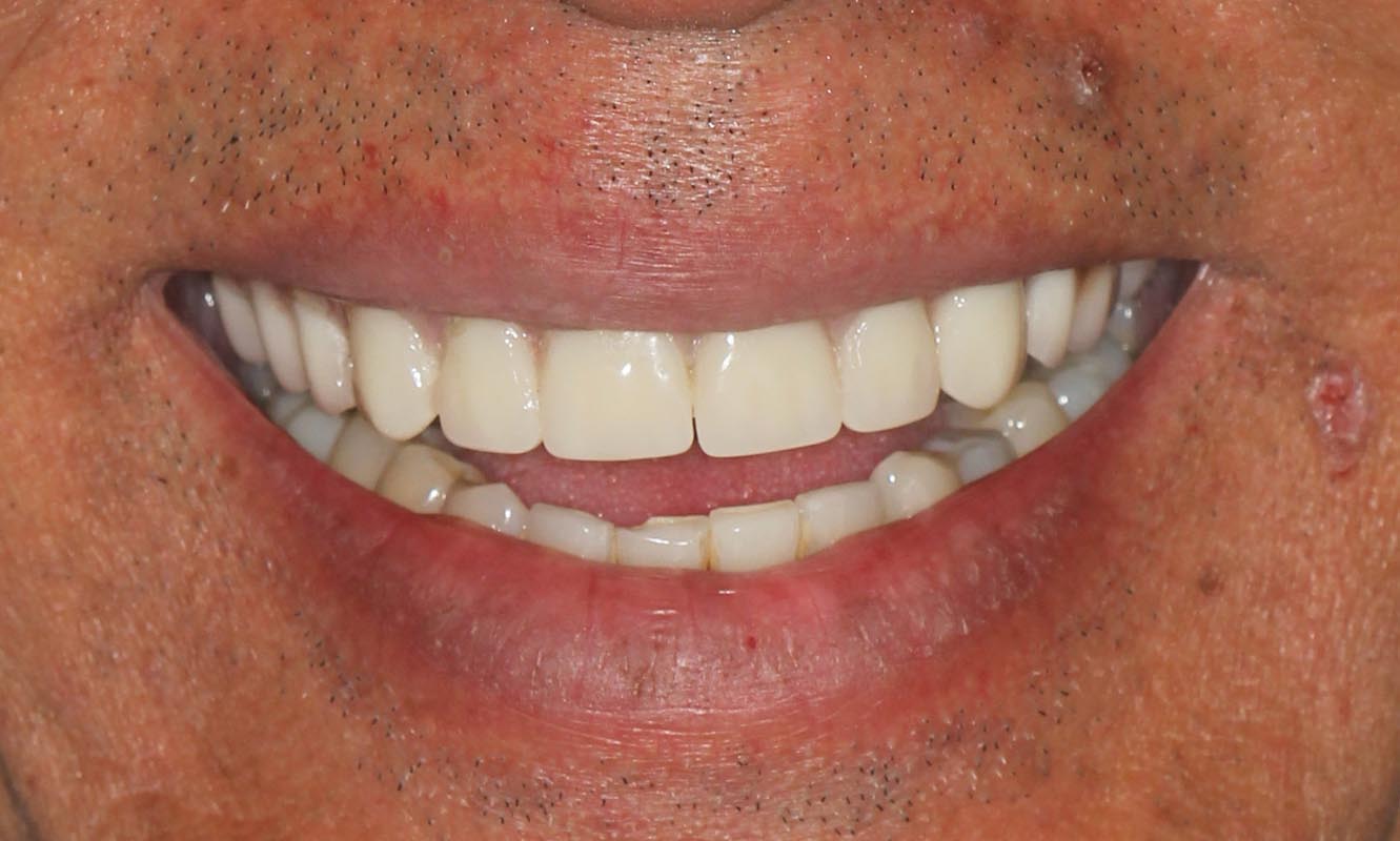 Full Arch/Full Mouth Implant Bridges Before