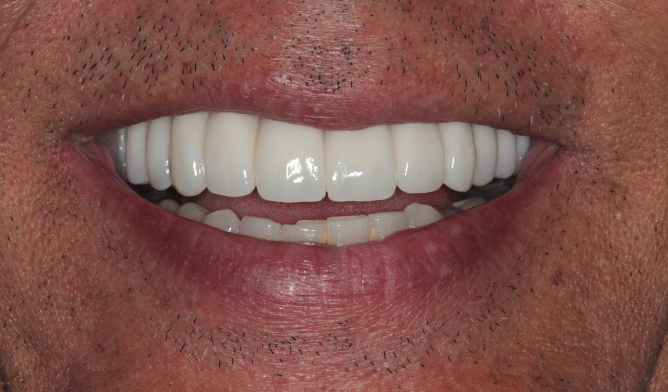 Full Arch/Full Mouth Implant Bridges After