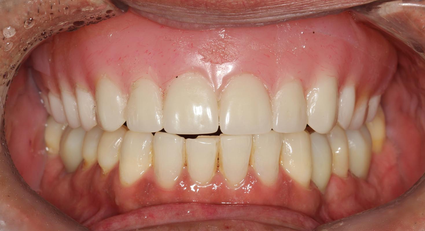 Full Arch/Full Mouth Implant Bridges Before