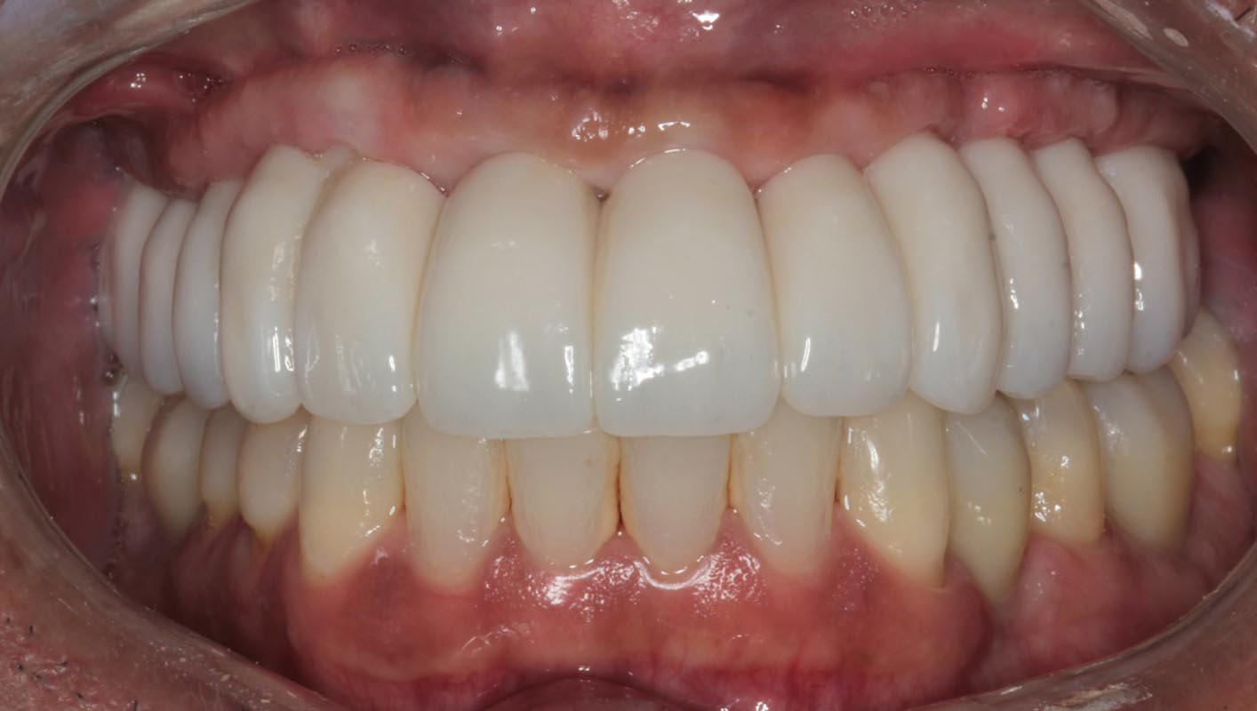 Full Arch/Full Mouth Implant Bridges After