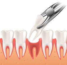 "What to expect when getting dental implants, tooth removal"