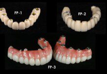 When FP1 and FP2 Implant Bridges Are Better Than All-on-4