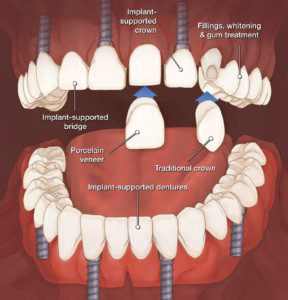 What IS a Prosthodontist? - Dental Implant Center