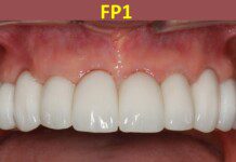 FP1, FP2, and FP3 Dental Prostheses: What’s the Difference?