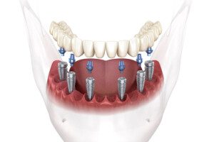 Diagram showing parallel implants, strategically placed for ideal esthetic results on full arch implant bridge.