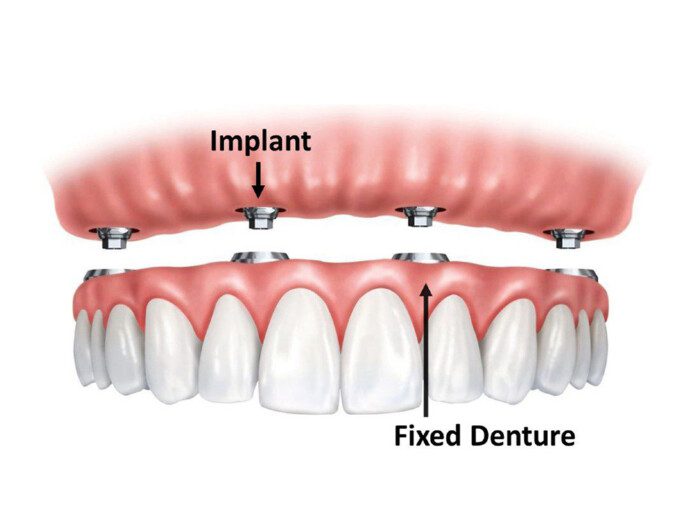 Fixed Dentures Everything You Need To Know Dental Implant Center
