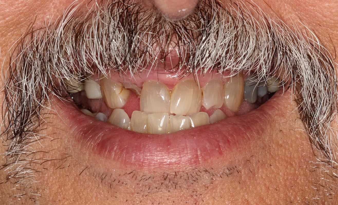 Full Arch/Full Mouth Implant Bridges Before