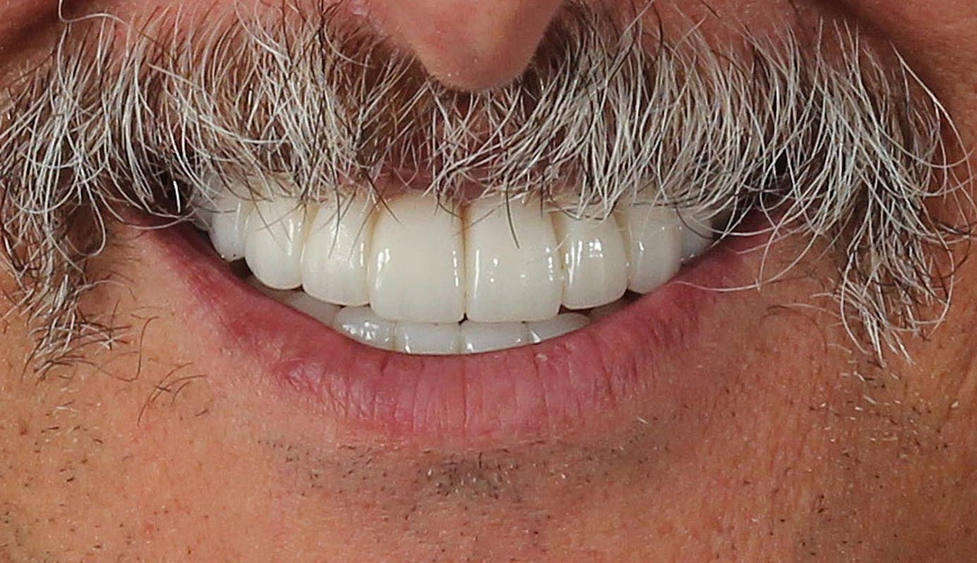 Full Arch/Full Mouth Implant Bridges After