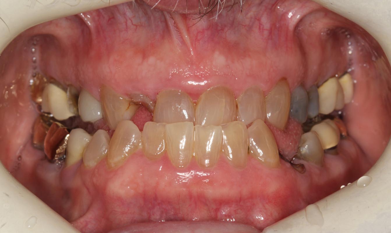 Full Arch/Full Mouth Implant Bridges Before