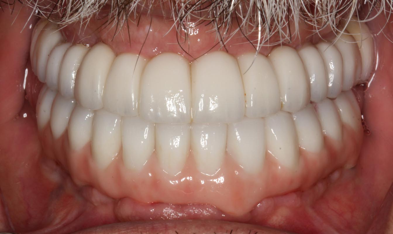 Full Arch/Full Mouth Implant Bridges After