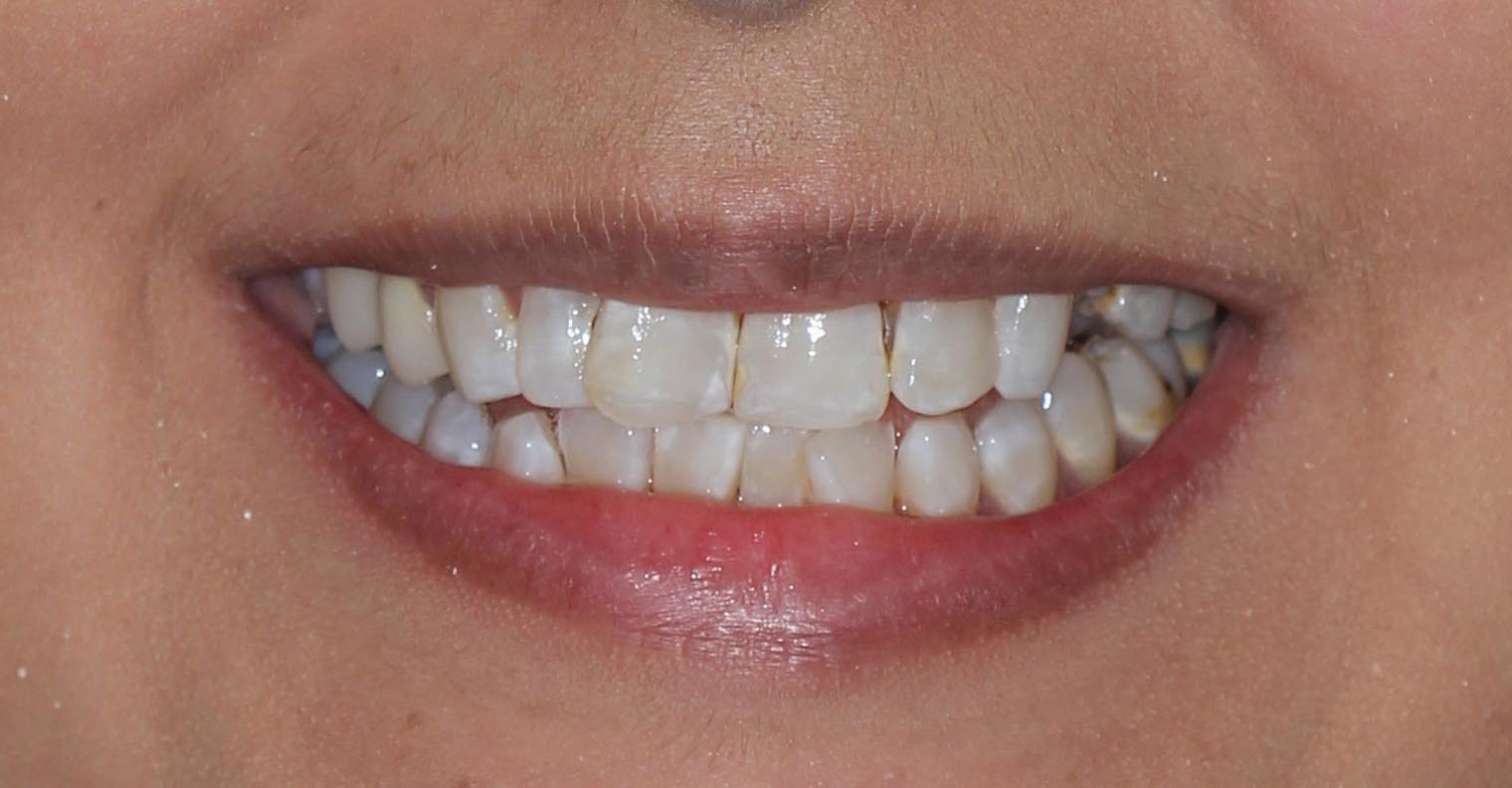 Full Arch/Full Mouth Implant Bridges Before